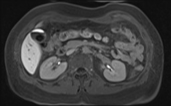 File:Normal hepatobiliary phase liver MRI (Radiopaedia 58968-66230 A 59).jpg