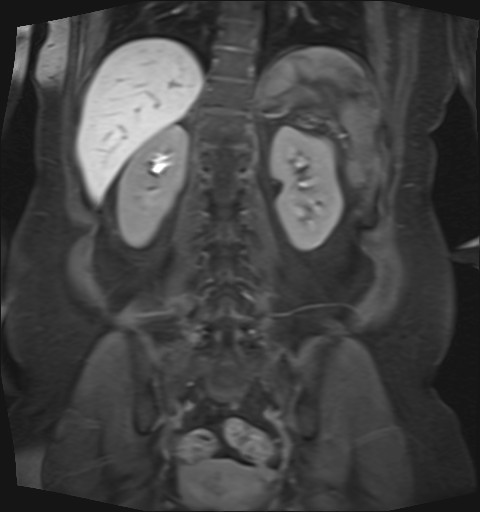 File:Normal hepatobiliary phase liver MRI (Radiopaedia 58968-66230 B 14).jpg