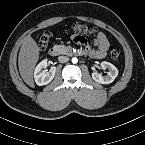 Normal kidneys on 4-phase CT study (Radiopaedia 25889-26038 B 40).jpg