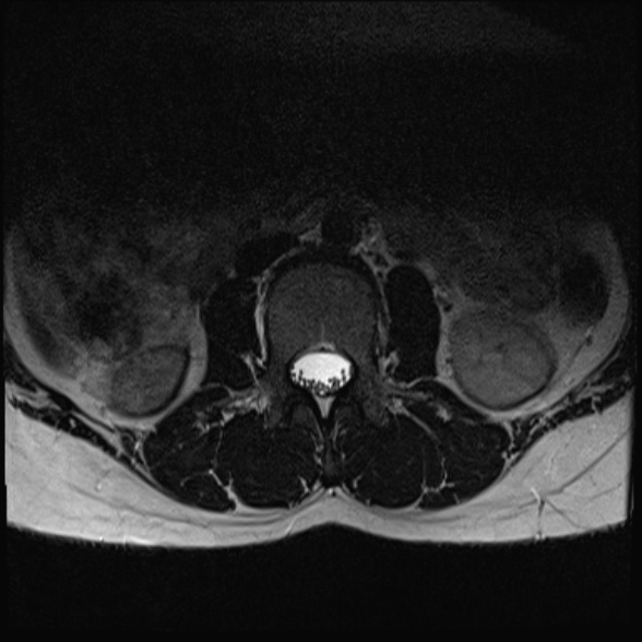 File:Normal lumbar spine MRI- 3 T (Radiopaedia 53280-59250 Axial T2 2).jpg