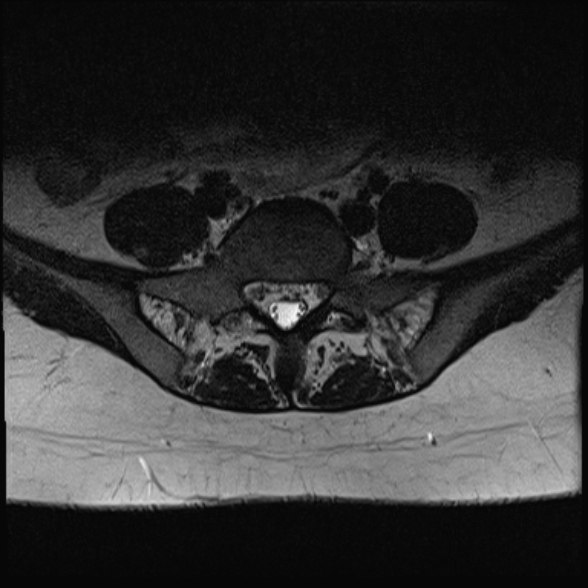 File:Normal lumbar spine MRI- 3 T (Radiopaedia 53280-59250 Axial T2 29).jpg