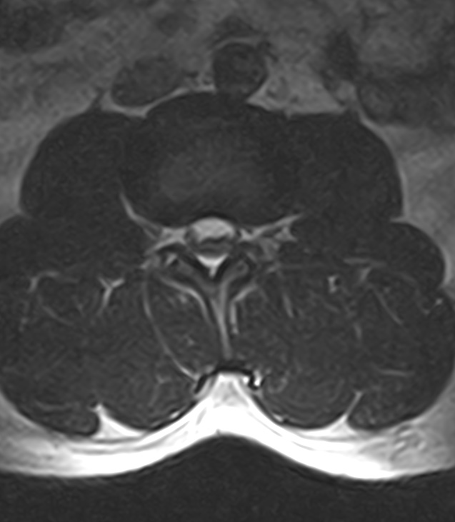 Normal lumbar spine MRI - low-field MRI scanner (Radiopaedia 40976-43699 Axial T2 46).jpg