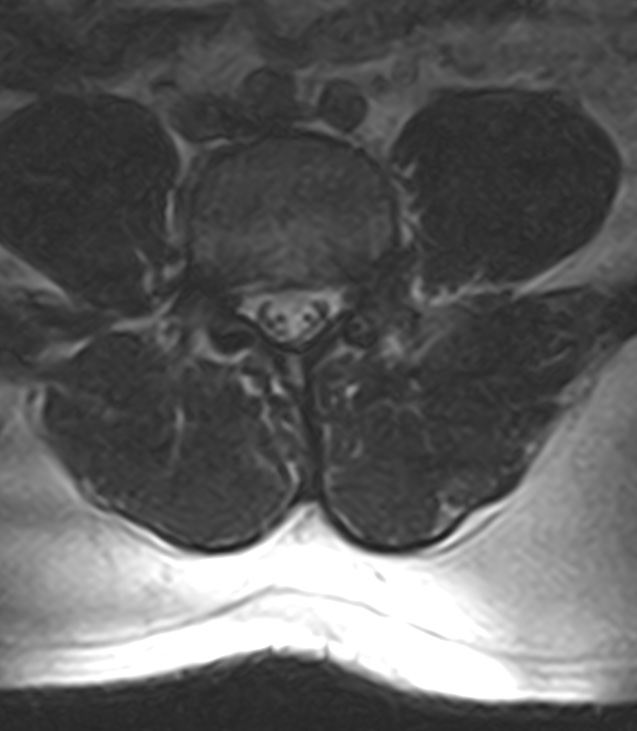 Normal lumbar spine MRI - low-field MRI scanner (Radiopaedia 40976-43699 Axial T2 69).jpg