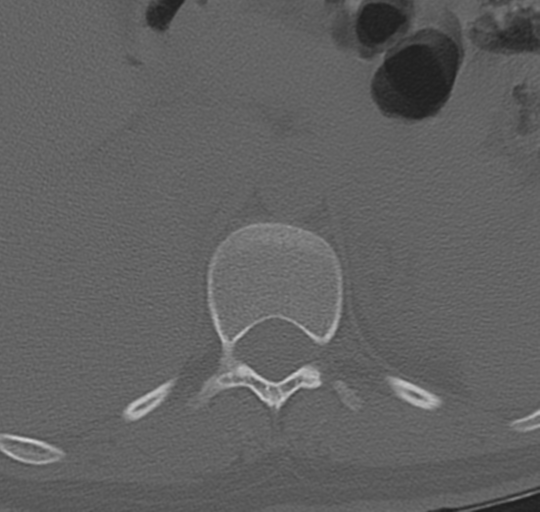 File:Normal lumbosacral CT (Radiopaedia 37923-39867 Axial bone window 13).png