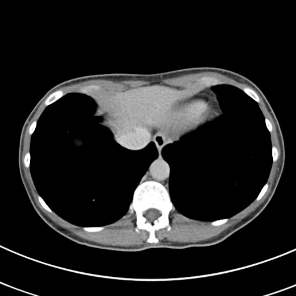 File:Normal multiphase CT liver (Radiopaedia 38026-39996 Axial C+ delayed 5).jpg