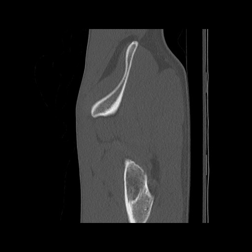 Normal pelvis (Radiopaedia 51473-57238 Sagittal bone window 23).jpg