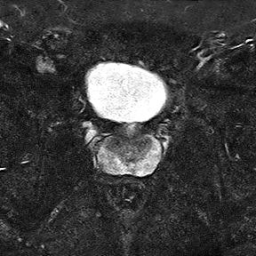 File:Normal prostate (MRI) (Radiopaedia 29986-30535 Axial STIR 9).jpg