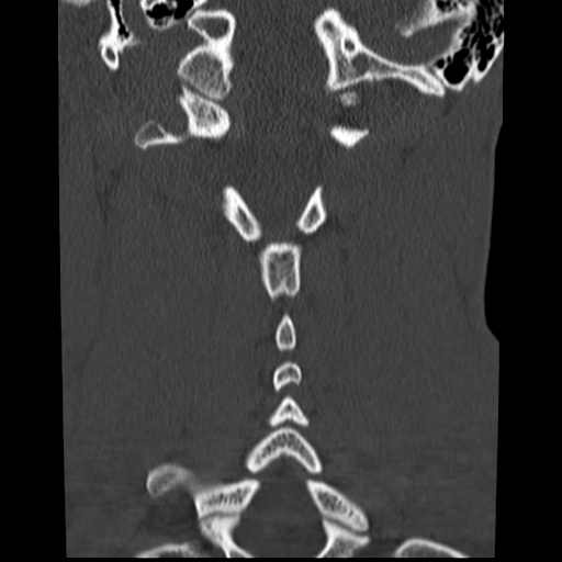 File:Normal trauma cervical spine (Radiopaedia 41017-43760 Coronal bone window 28).png