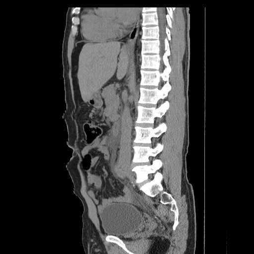File:Obstructed kidney with perinephric urinoma (Radiopaedia 26889-27066 B 29).jpg