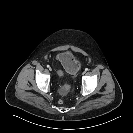 Obstructing sigmoid adenocarcinoma (Radiopaedia 58465-65619 A 145).jpg