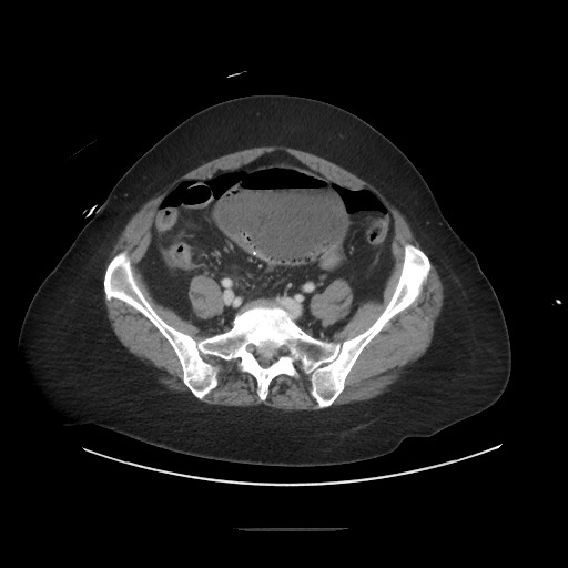 Obstructive distal colonic adenocarcinoma causing cecal perforation (Radiopaedia 86830-102989 A 143).jpg