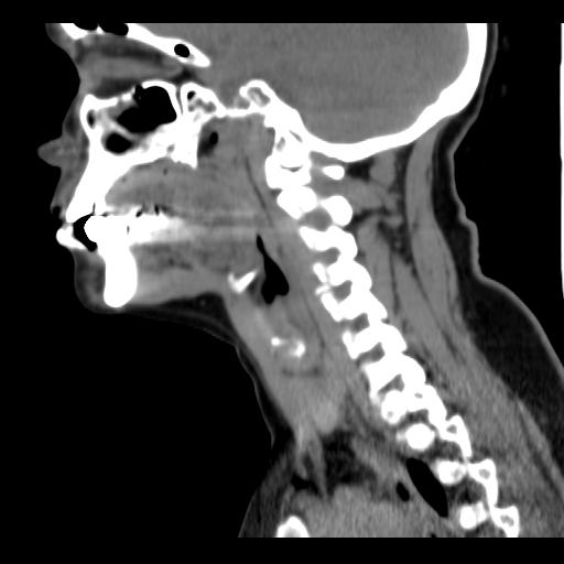 File:Obstructive sleep apnea (CT evaluation) (Radiopaedia 24304-24582 C 44).jpg