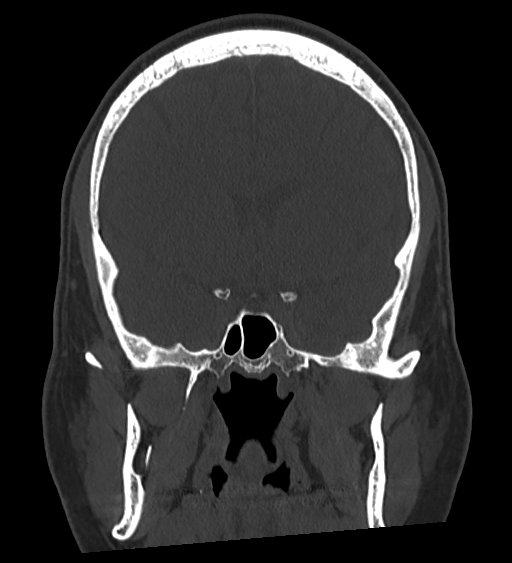 Occipital spur and Currarino type A atlas anomaly (Radiopaedia 87027-103285 Coronal bone window 70).jpg