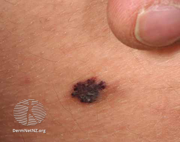 File:Pigmented angiokeratoma (DermNet NZ lesions-s-pigmented-lesion-13).jpg