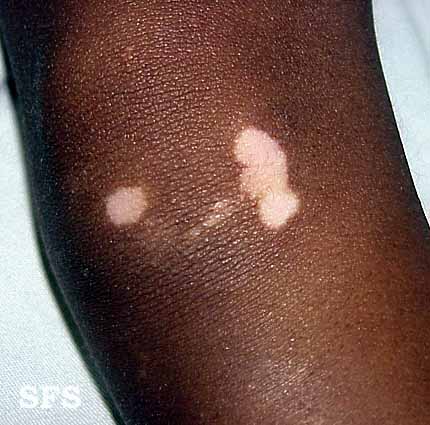 File:Vitiligo (Dermatology Atlas 3).jpg