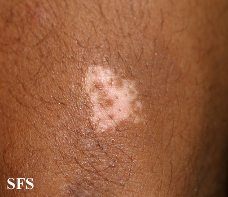 File:Vitiligo (Dermatology Atlas 41).jpg