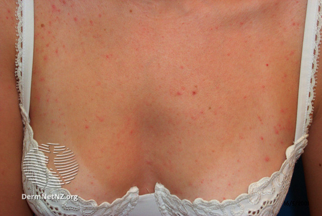 File:(DermNet NZ acne-folliculitis-2655).jpg