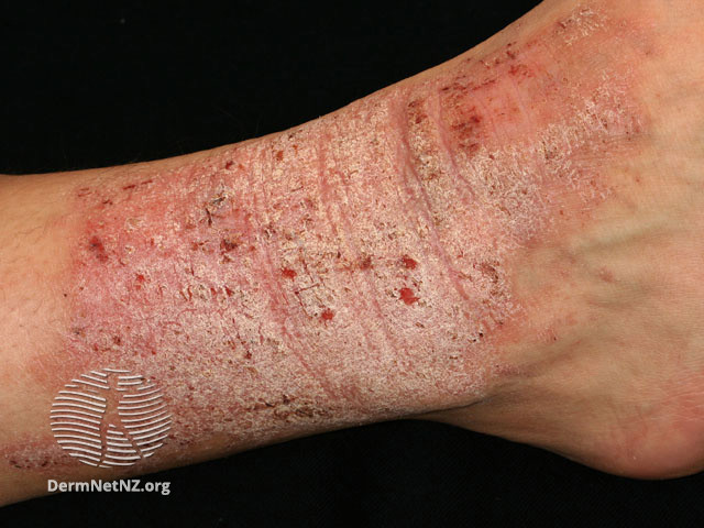 File:(DermNet NZ dermatitis-lichen-simplex-3124).jpg