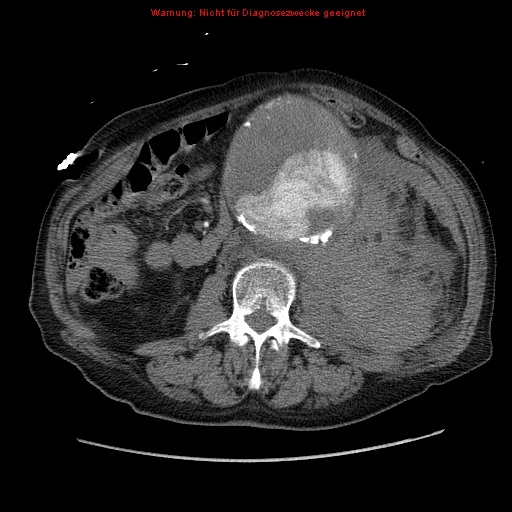 File:Abdominal aortic aneurysm- extremely large, ruptured (Radiopaedia 19882-19921 Axial C+ arterial phase 36).jpg