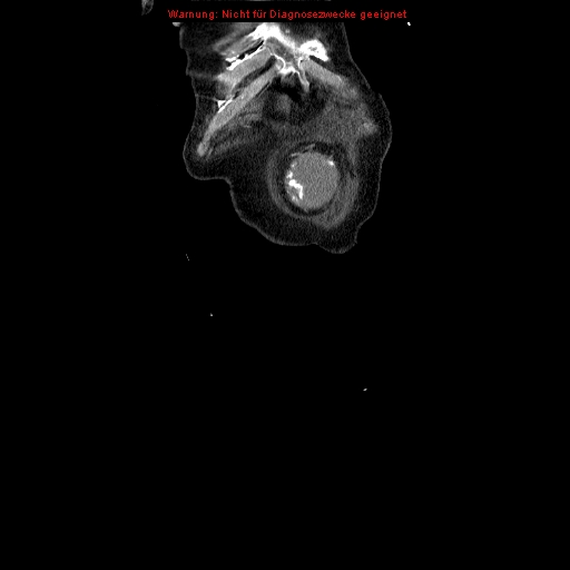 Abdominal aortic aneurysm- extremely large, ruptured (Radiopaedia 19882-19921 Coronal C+ arterial phase 6).jpg