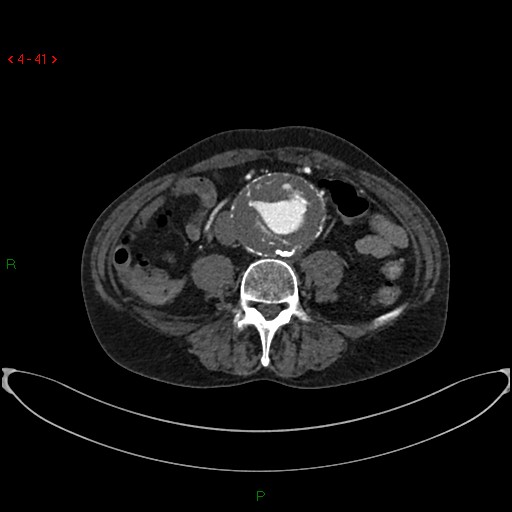 File:Abdominal aortic aneurysm (Radiopaedia 16155-15834 Axial C+ arterial phase 21).jpg