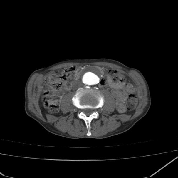Abdominal aortic aneurysm (Radiopaedia 23703-23856 Axial C+ arterial phase 45).jpg