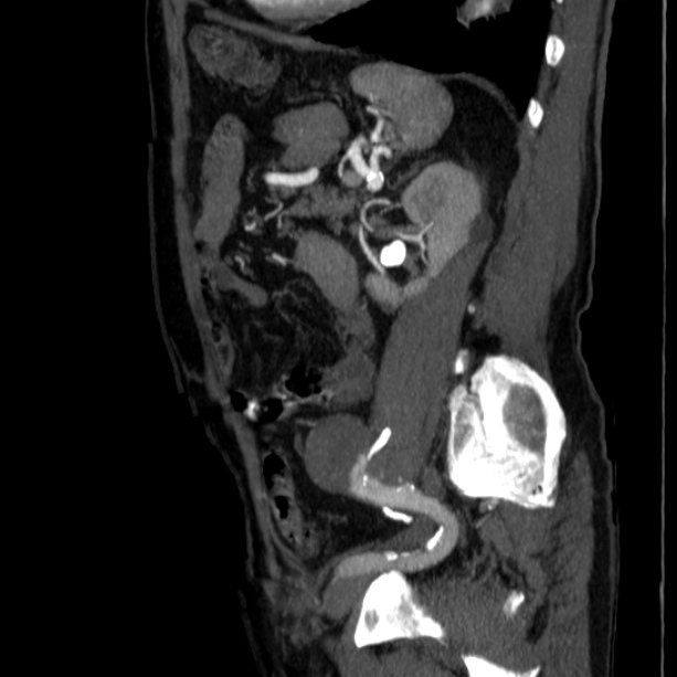 Abdominal aortic aneurysm (Radiopaedia 29248-29660 Sagittal C+ arterial phase 38).jpg