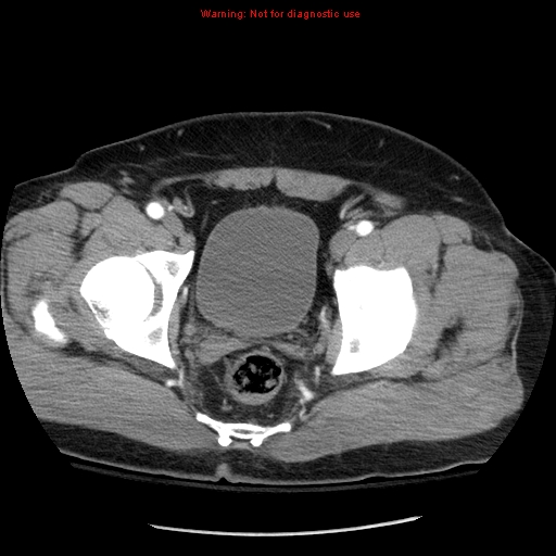 Abdominal aortic aneurysm (Radiopaedia 8190-9038 Axial C+ arterial phase 77).jpg