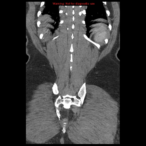 Abdominal aortic aneurysm (Radiopaedia 8190-9038 Coronal C+ arterial phase 114).jpg
