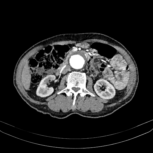 Abdominal aortic aneurysm (Radiopaedia 83581-98689 Axial C+ arterial phase 57).jpg
