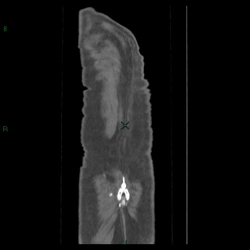 File:Abdominal aortic aneurysm rupture with aortocaval fistula (Radiopaedia 14897-14841 Coronal C+ arterial phase 40).jpg