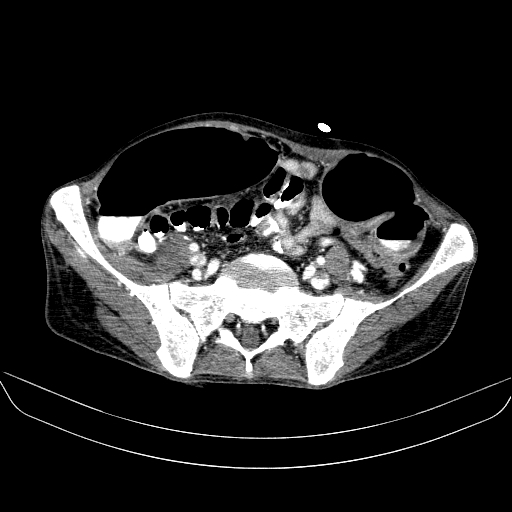 File:Abdominal collection due to previous cecal perforation (Radiopaedia 80831-94320 Axial C+ portal venous phase 150).jpg