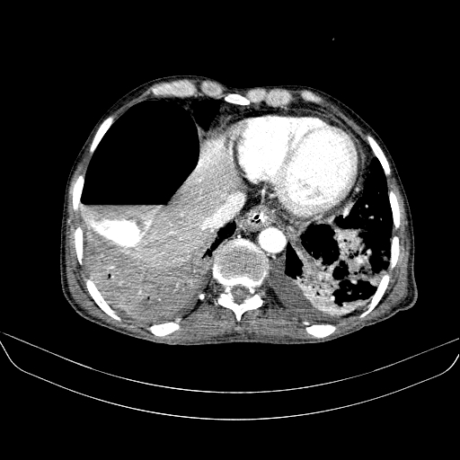 File:Abdominal collection due to previous cecal perforation (Radiopaedia 80831-94320 Axial C+ portal venous phase 19).jpg
