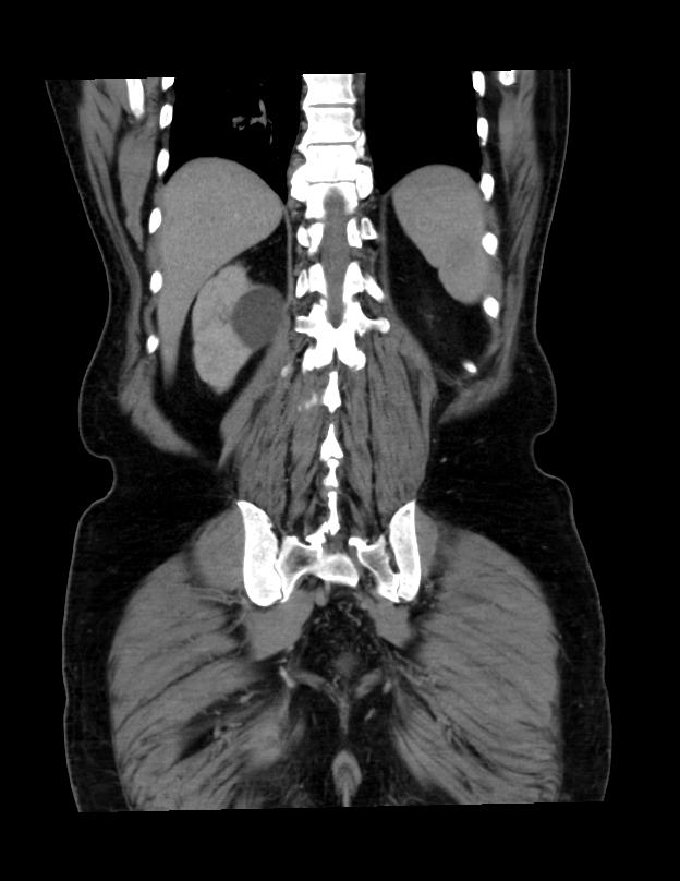 Abdominal lymphoma - with sandwich sign (Radiopaedia 53486-59492 C+ portal venous phase 11).jpg
