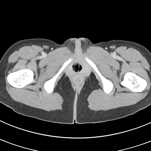 File:Abdominal multi-trauma - devascularised kidney and liver, spleen and pancreatic lacerations (Radiopaedia 34984-36486 Axial C+ delayed 86).png