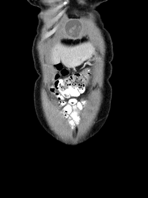 Abdominal wall and retroperitoneal tuberculosis (Radiopaedia 88137-104729 Coronal C+ portal venous phase 13).jpg