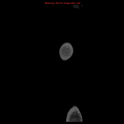 Abdominal wall hematoma (Radiopaedia 9427-10112 Sagittal C+ portal venous phase 117).jpg