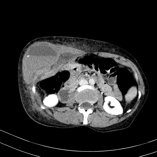 File:Abdominal wall hematoma with active bleeding (Radiopaedia 83915-99122 Axial contrast-enhanced CT 10).jpg