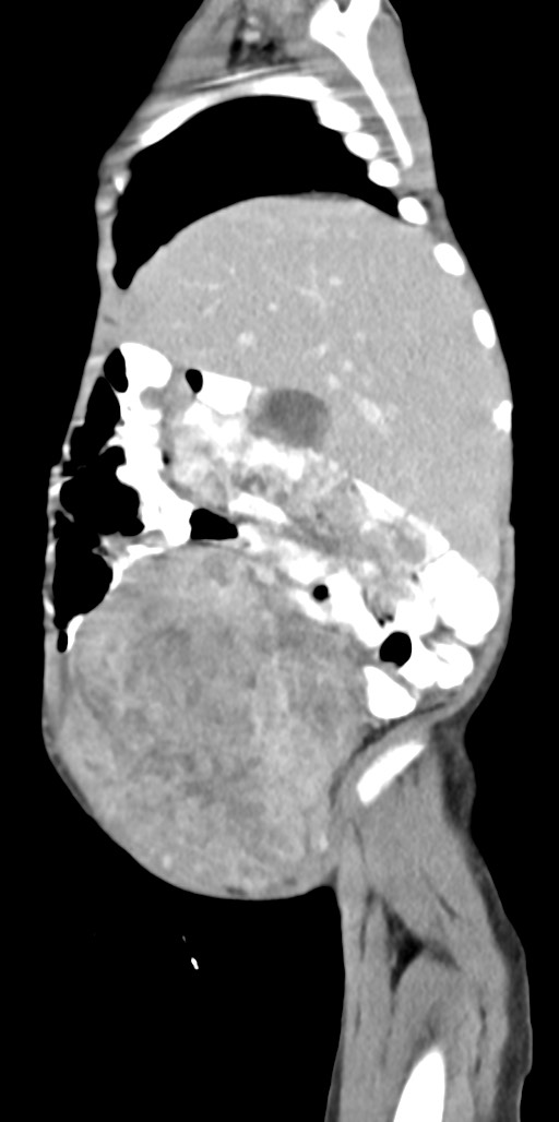 Abdominopelvic rhabdomyosarcoma (Radiopaedia 78356-90984 Sagittal C+ portal venous phase 79).jpg