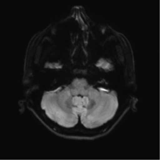 File:Abducens nerve palsy (Radiopaedia 51069-56648 Axial DWI 32).png