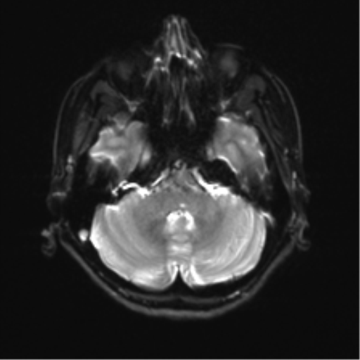 File:Abducens nerve palsy (Radiopaedia 51069-56648 Axial DWI 6).png