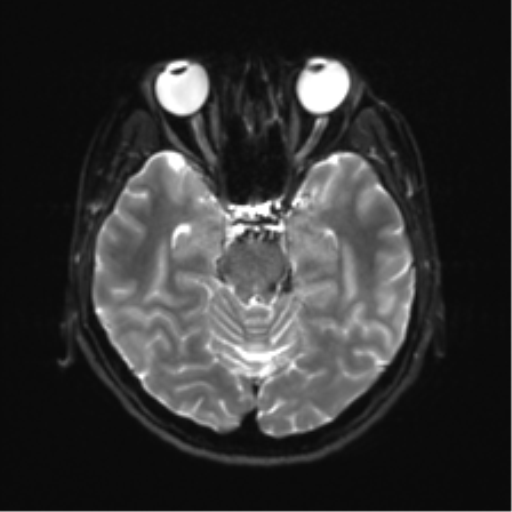 Abducens nerve palsy (Radiopaedia 51069-56648 Axial DWI 9).png