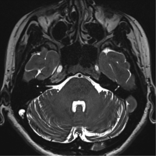 Abducens nerve palsy (Radiopaedia 51069-56648 Axial T2 fat sat 28).png