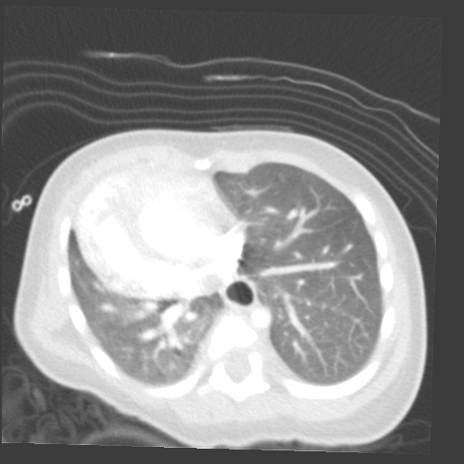 File:Aberrant left pulmonary artery (pulmonary sling) (Radiopaedia 42323-45435 Axial lung window 25).jpg