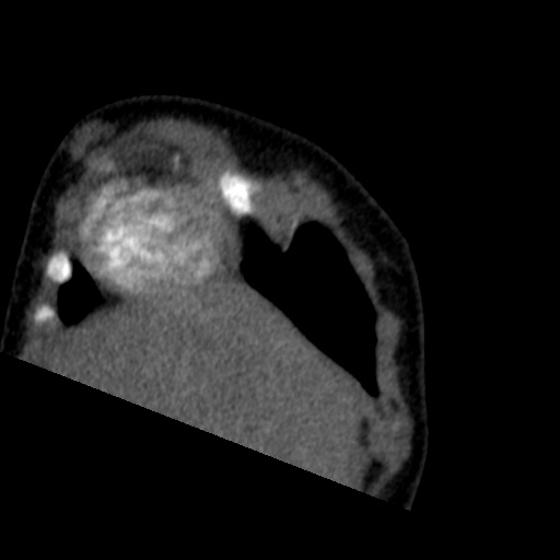 File:Aberrant left pulmonary artery (pulmonary sling) (Radiopaedia 42323-45435 Coronal C+ CTPA 25).jpg