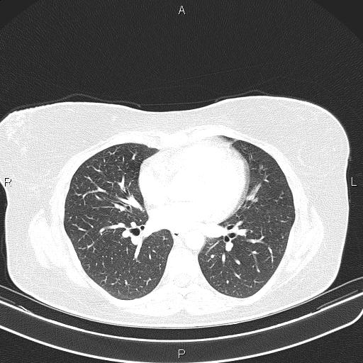 Aberrant right subclavian artery (Radiopaedia 87334-103629 Axial lung window 38).jpg