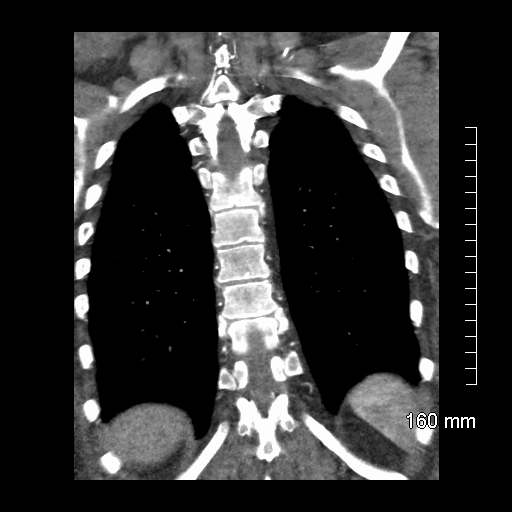 Aberrant right subclavian artery stenosis (Radiopaedia 52656-58670 B 68).jpg