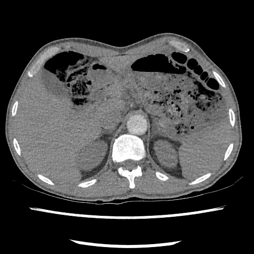 Accessory left horizontal fissure with lingular pneumonia (Radiopaedia 53763-59843 Axial C+ CTPA 89).jpg
