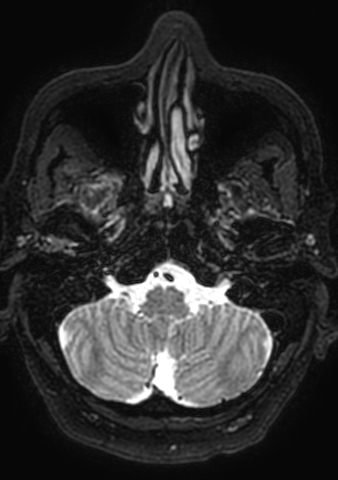 Accessory middle cerebral artery (Radiopaedia 73114-83828 Axial T2 191).jpg