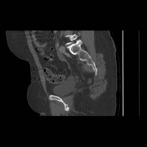 File:Acetabular fracture (Radiopaedia 13193-13212 Sagittal bone window 38).jpg